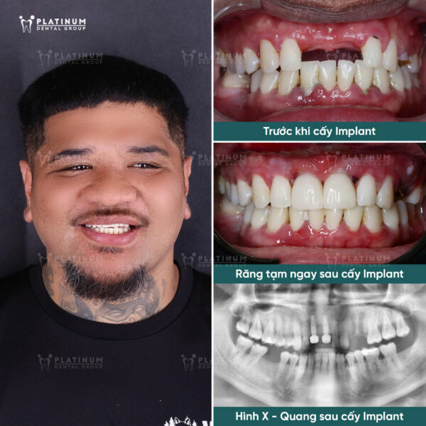 Địa chỉ trồng răng Implant uy tín tại TP.HCM - Bí quyết chọn nha khoa chất lượng và an toàn 12 Trường hợp trồng răng Implant của Mr. Dean Amo Ewe, khách hàng đến từ New Zealand