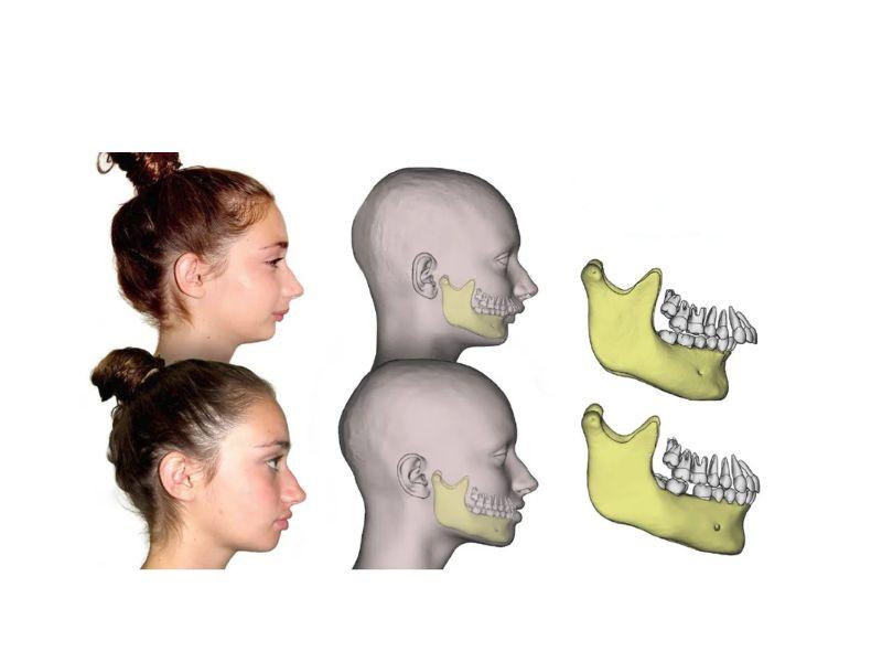Ảnh minh hoạ răng hô cằm lẹm