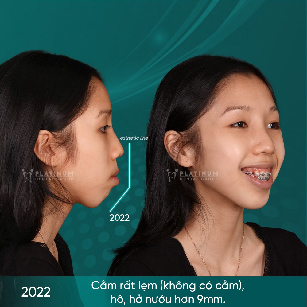 Hình ảnh khuôn mặt và răng trước khi điều trị: hô nặng, môi không khép kín, hở nướu, khớp cắn lệch khiến bé khó ăn nhai và mất tự tin