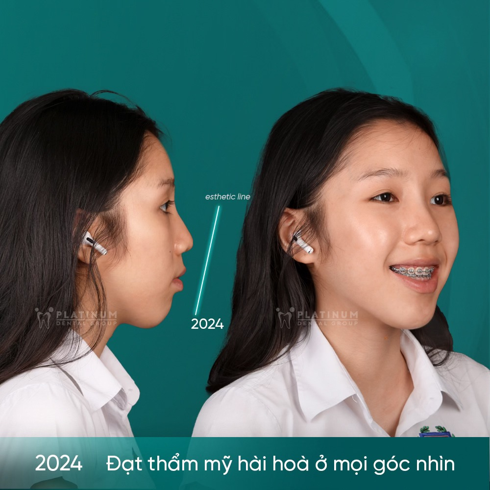 Khuôn mặt hài hòa hơn, môi khép tự nhiên, nụ cười cân đối; chức năng ăn nhai cải thiện rõ rệt và bé tăng được 3kg – minh chứng cho hiệu quả điều trị đúng hướng