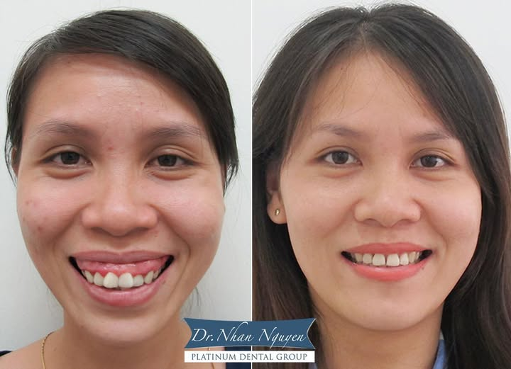 Hình ảnh trước - sau khi điều trị răng hô của chị bệnh nhân 28 tuổi