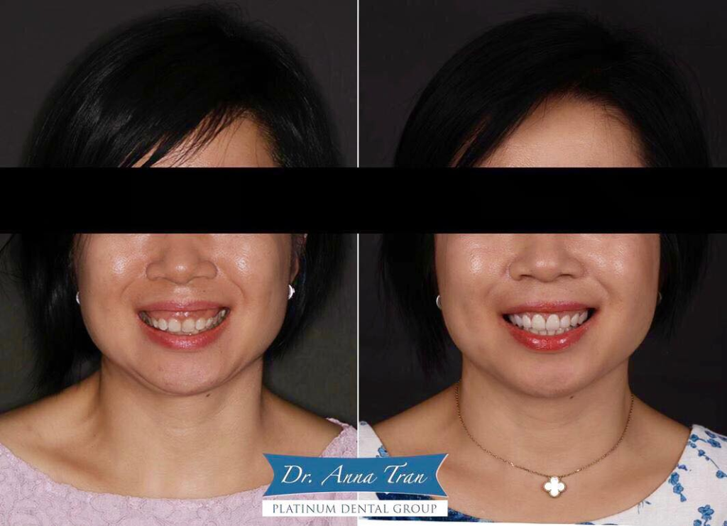 Hình ảnh trước và sau điều trị hô xương hàm của chị Tú