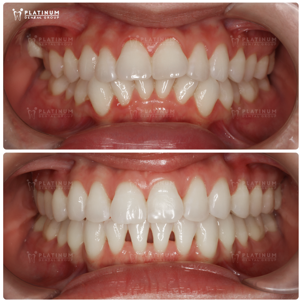 Răng hô là dạng sai lệch khớp cắn thường gặp nhất, có thể xuất phát từ răng, xương hàm hoặc cả hai