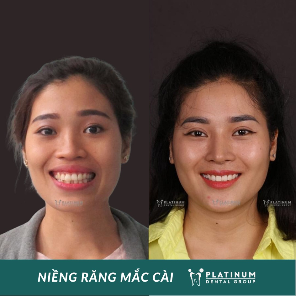 Sự thay đổi ngoạn mục của bệnh nhân sau khi chỉnh nha tại Platinum Dental Group