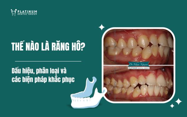 Thế nào là răng hô