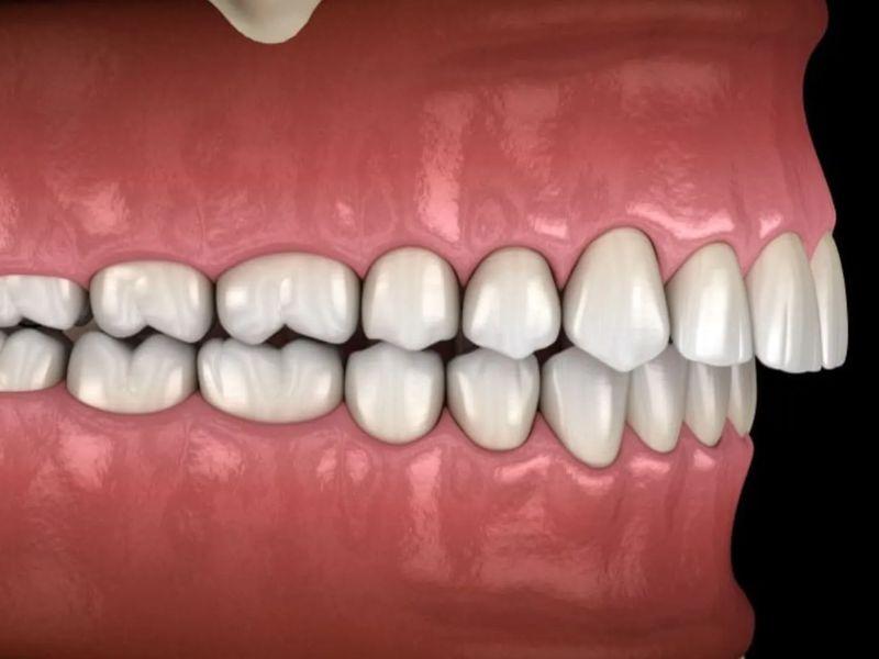 Ảnh minh hoạ hô răng