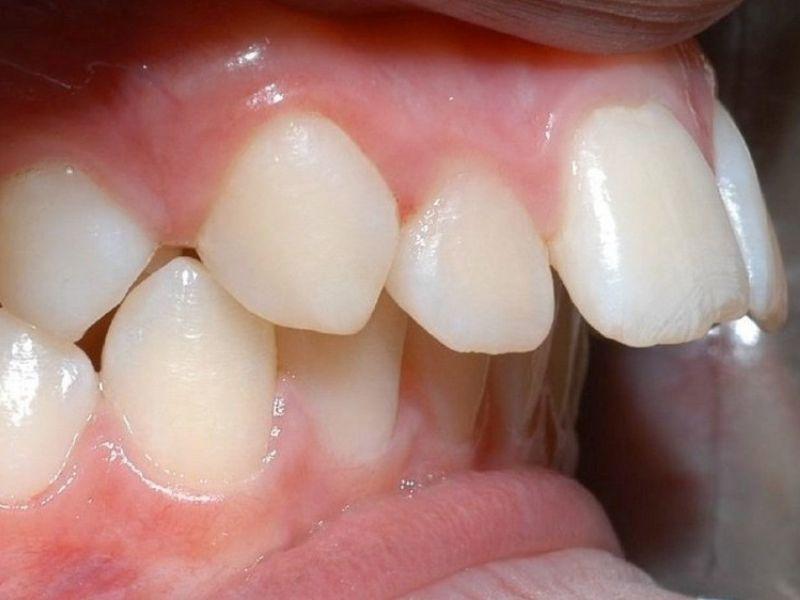 Dấu hiệu nhận biết răng của bạn bị hô nặng