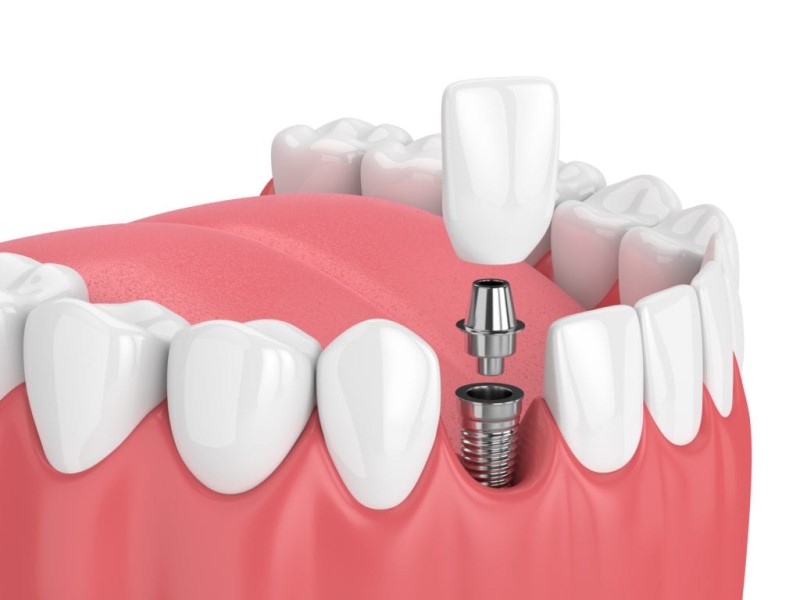 Dental implant healing stages: How long does it take for dental implants to heal?