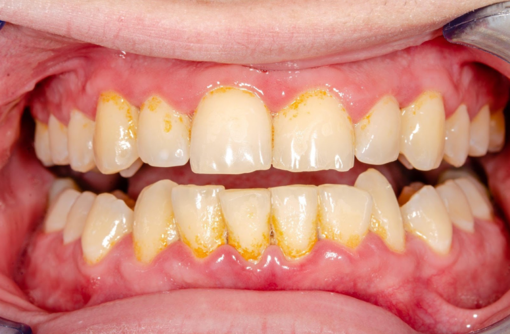 Vôi Răng Là Gì? Nguyên Nhân, Triệu Chứng Và Cách Phòng Ngừa 1 nguyen nhan gay ra voi rang