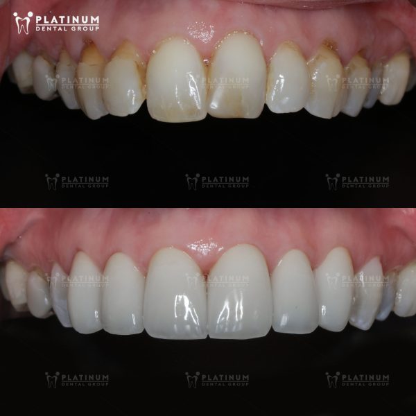 Nhiều người thắc mắc: bọc răng sứ có tốt không?