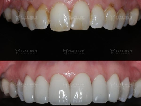 Bọc răng sứ có tốt không? Đánh giá từ A đến Z 1 Nhiều người thắc mắc: bọc răng sứ có tốt không?