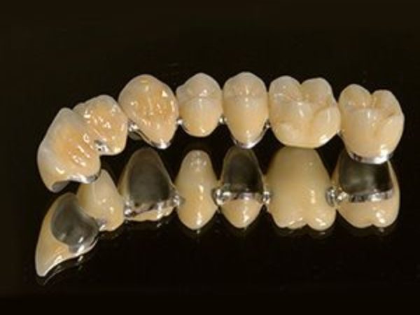 Bọc răng sứ có tốt không? Đánh giá từ A đến Z 4 Răng sứ kim loại có lõi bên trong bằng kim loại và phủ men sứ bên ngoài