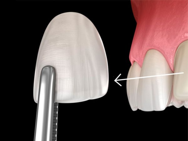 Dán răng sứ có thể tháo ra được không?