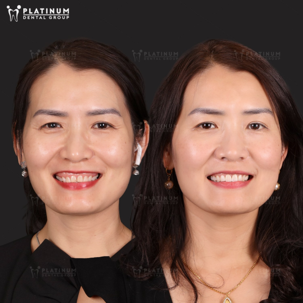 Dán răng sứ thường chỉ phù hợp với những trường hợp răng còn khỏe, ít khuyết điểm