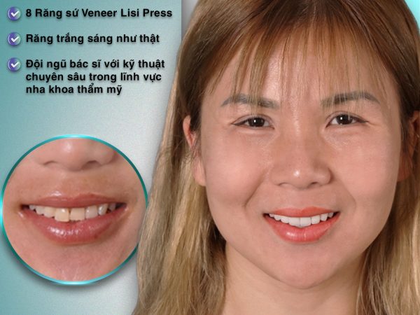 Quy trình dán răng sứ ít xâm lấn nên hầu như không gây đau đớn