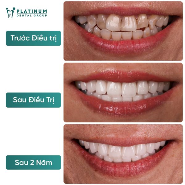 Tìm hiểu về ưu - nhược điểm của dán răng sứ 5 Chi phí dán sứ cao hơn khá nhiều so với các phương pháp khác