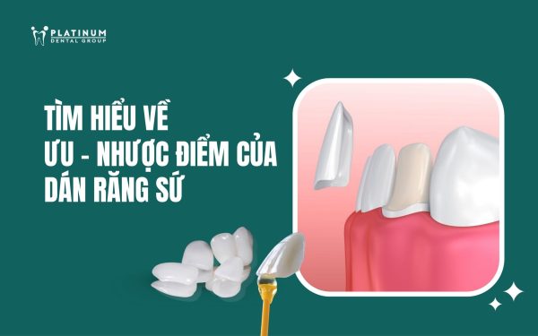 nhược điểm của dán răng sứ