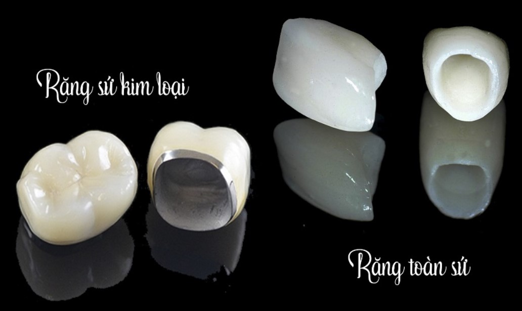 rang su kim loai va rang toan su