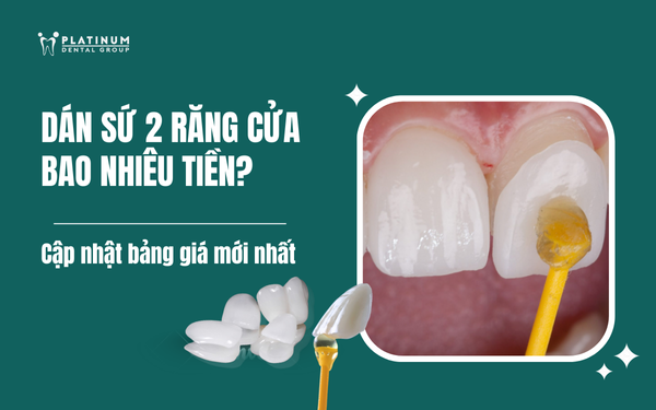 dán sứ 2 răng cửa bao nhiêu tiền