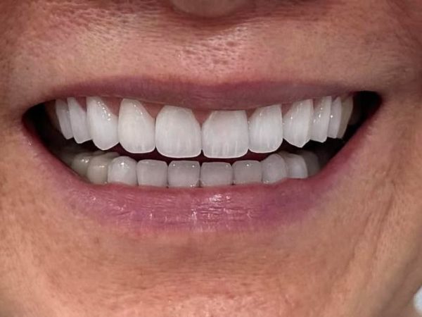 Làm răng sứ mất bao lâu? Tìm hiểu quy trình thực hiện và những lưu ý quan trọng 1 Làm răng sứ mất bao lâu sẽ phụ thuộc vào nhiều yếu tố khác nhau