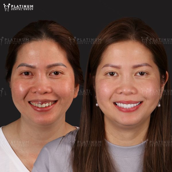 Sau bọc răng sứ, bạn có thể ăn nhai thoải mái chỉ sau vài ngày thích nghi