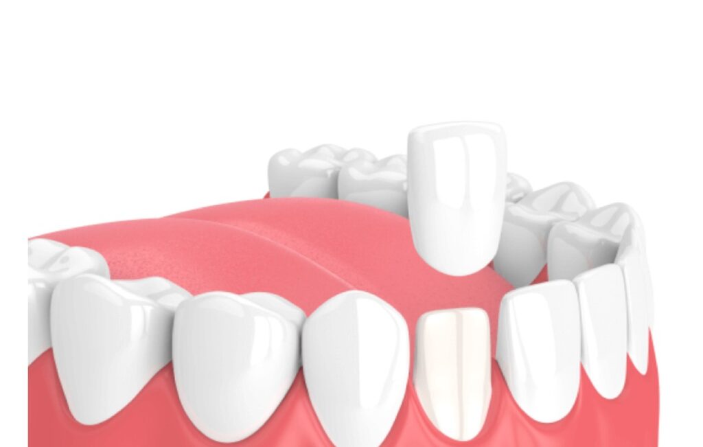 Lưu ý khi gắn răng tạm khi làm răng sứ