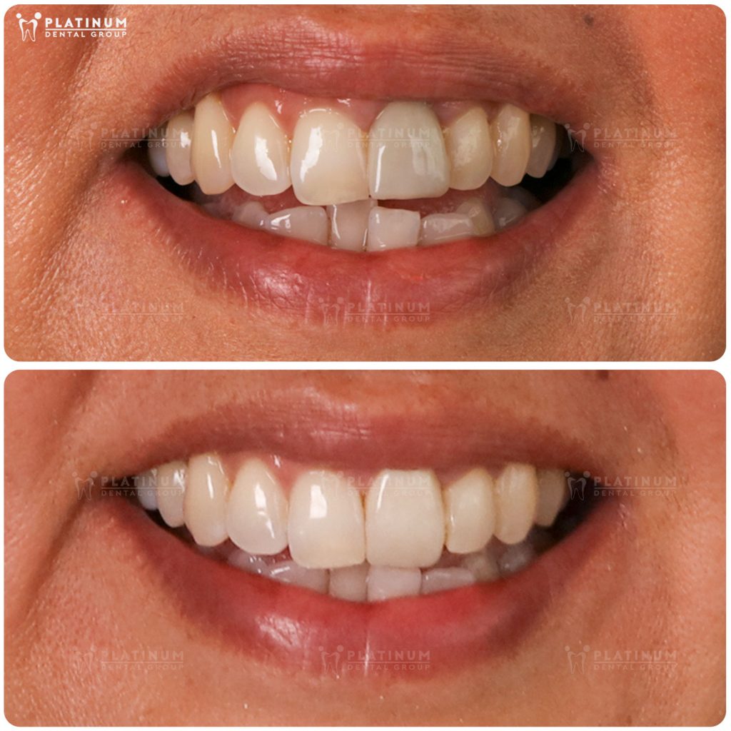 Trường hợp răng mọc hơi lệch, khấp khểnh nhẹ có thể bọc sứ để cải thiện hình dáng