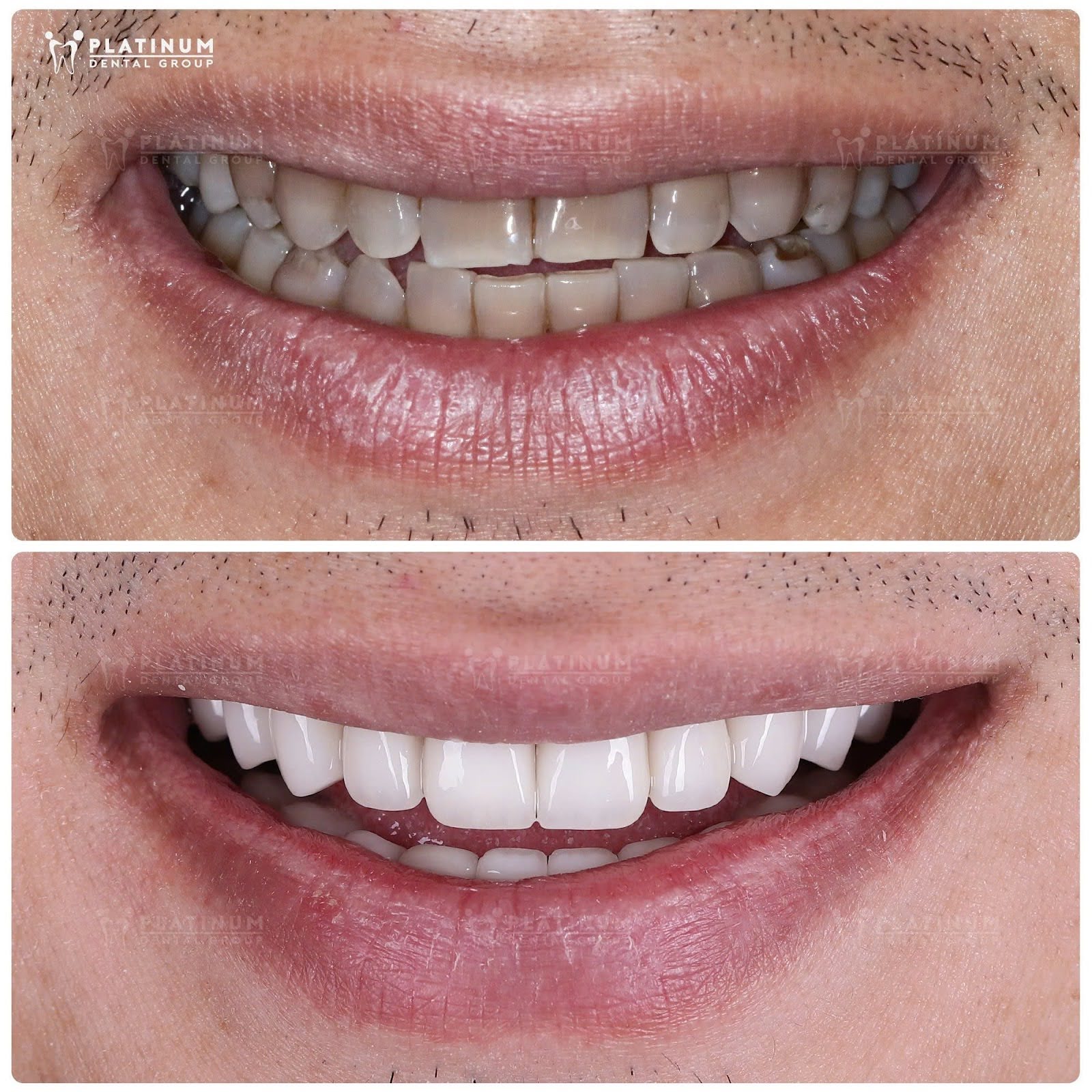 Khám phá quy trình làm răng sứ an toàn tại Platinum Dental Group