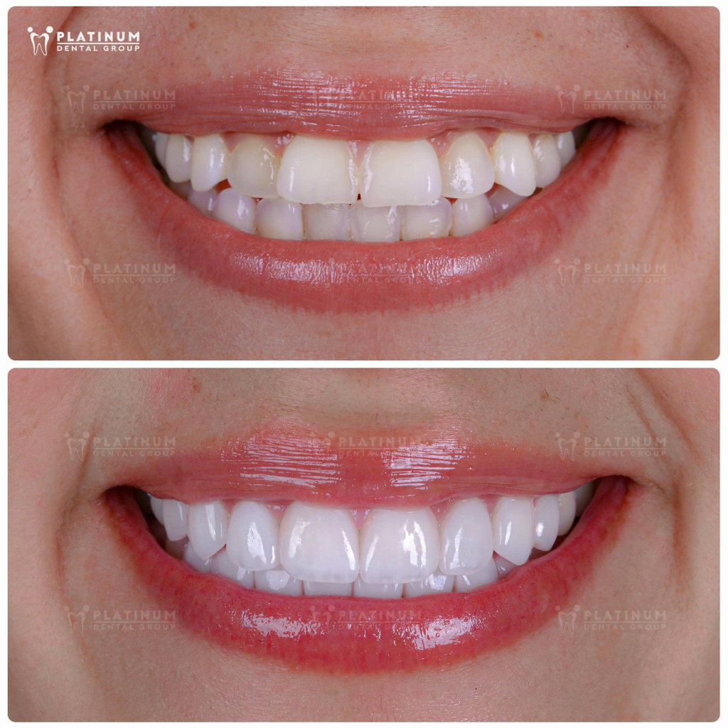 Nụ cười rạng rỡ, hoàn hảo hơn nhờ “tấm áp mới” Veneer tại Platinum Dental Group