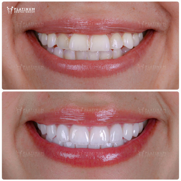 Nụ cười rạng rỡ, hoàn hảo hơn nhờ “tấm áp mới” Veneer tại Platinum Dental Group