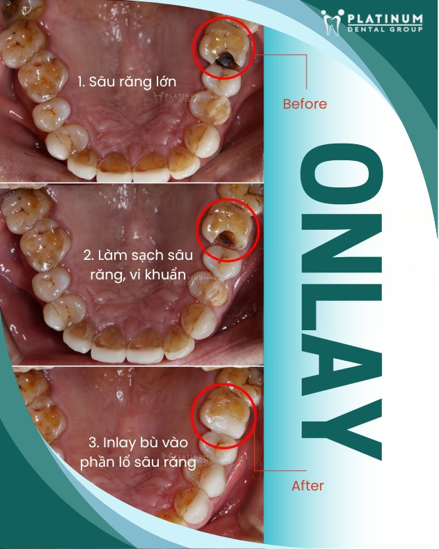 Inlay, onlay, overlay