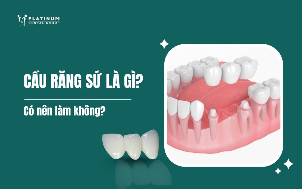 Cầu răng sứ là gì? Làm cầu răng sứ có tốt không? 1 cầu răng sứ là gì