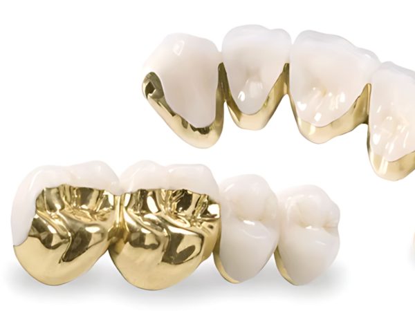 Cao cấp nhất trong nhóm này là răng sứ kim loại quý như vàng hoặc palladium