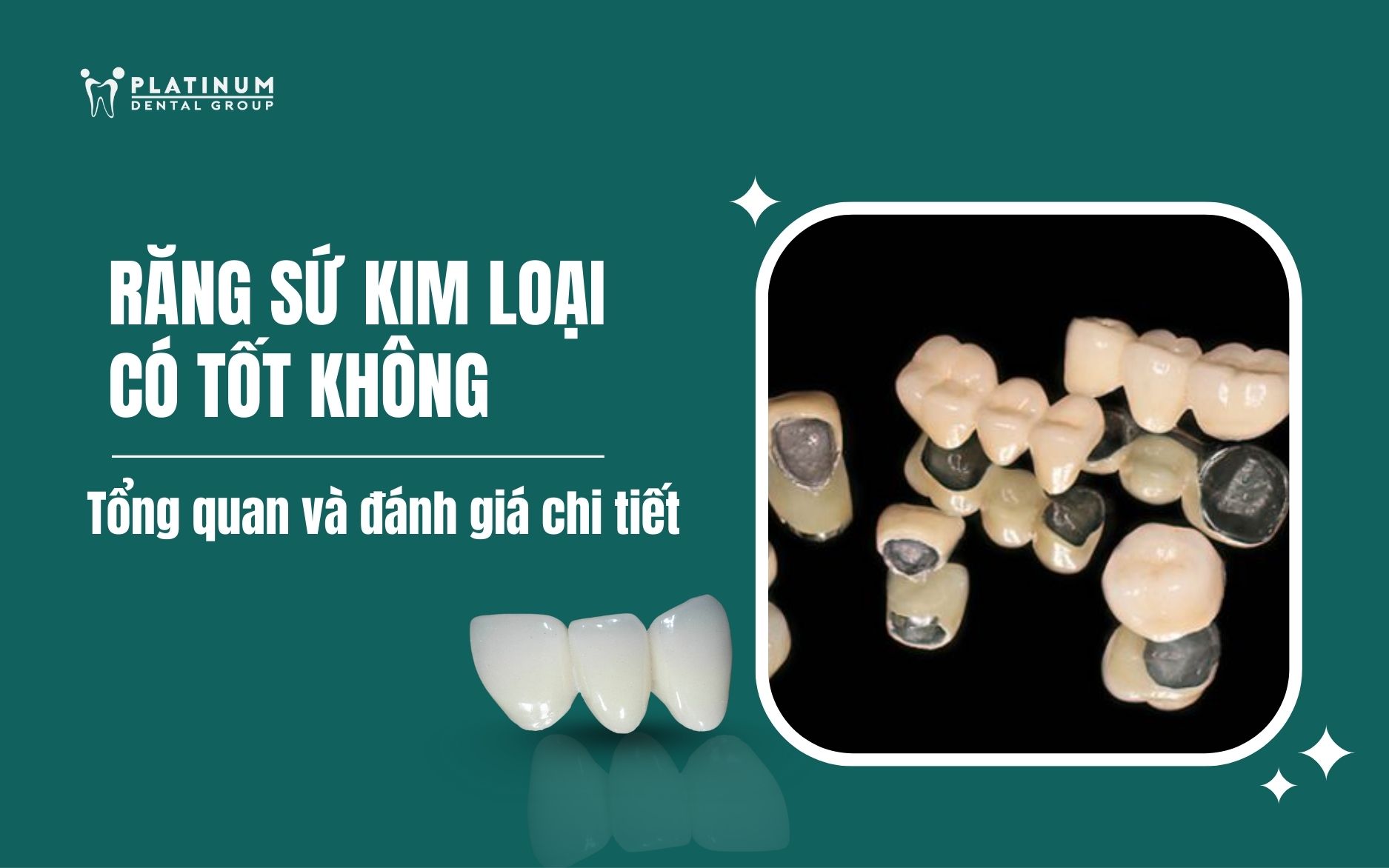 răng sứ kim loại có tốt không
