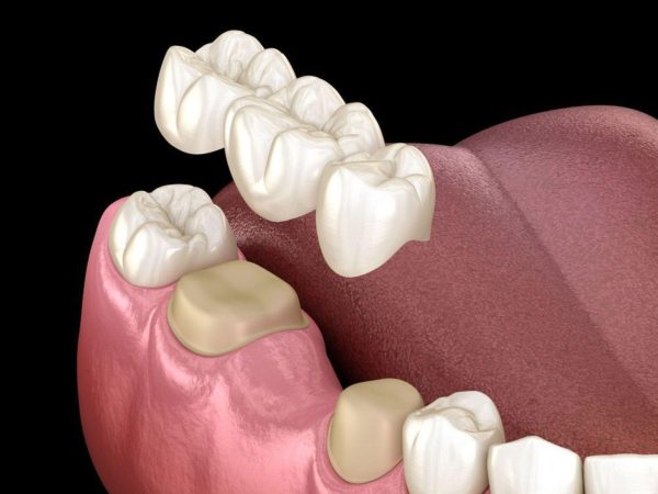 Answered: What is a dental bridge? Should you get one? 6 If you are missing one or more teeth, you can opt for a dental bridge