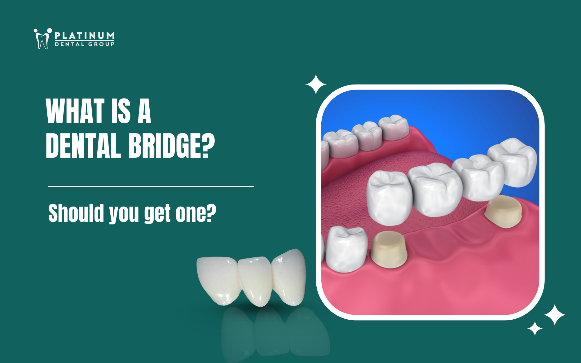What is a dental bridge