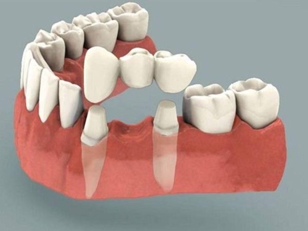 Answered: What is a dental bridge? Should you get one? 2 The traditional dental bridge is the most commonly used type today