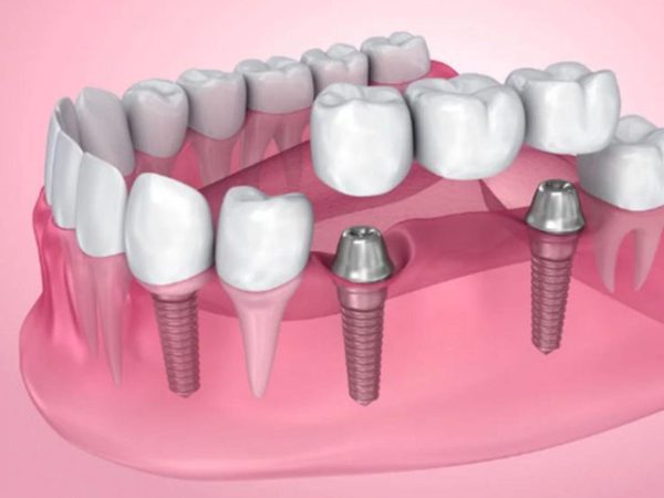 Answered: What is a dental bridge? Should you get one? 5 An implant-supported bridge is a combination of dental implants and a dental bridge