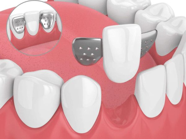 Answered: What is a dental bridge? Should you get one? 4 A Maryland bridge uses one or two small "wings" made of metal or porcelain