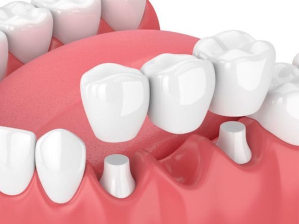 Answered: What is a dental bridge? Should you get one? 1 What is a dental bridge?