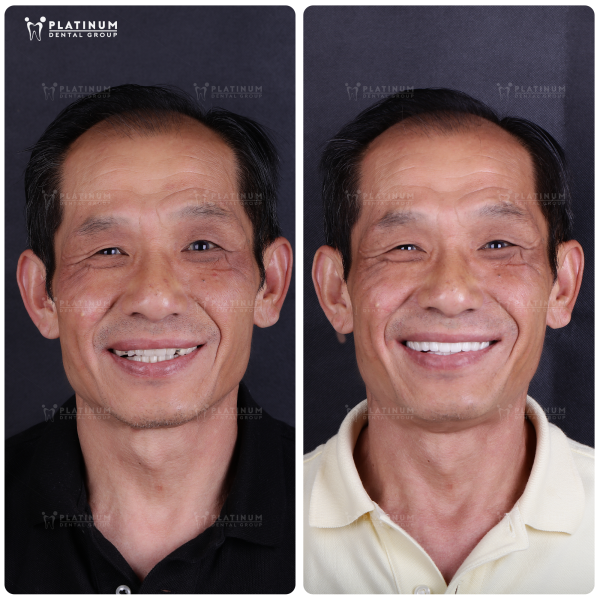 Answered: What is a dental bridge? Should you get one? 7 Clients who are not eligible for dental implants due to health or cost reasons