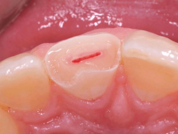 Bọc Răng Sứ Có Cần Lấy Tủy Không? Lấy Tủy Răng Có Bị Đau Không? 4 Răng bị vỡ, mẻ lớn lộ buồng tủy cần lấy tủy trước khi bọc răng sứ