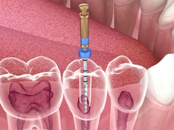 Bọc Răng Sứ Có Cần Lấy Tủy Không? Lấy Tủy Răng Có Bị Đau Không? 1 Lấy tủy răng là quá trình loại bỏ phần tủy bị viêm, hoại tử hoặc nhiễm khuẩn bên trong buồng tủy và ống tủy của răng
