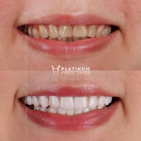 Bọc Răng Sứ Có Cần Lấy Tủy Không? Lấy Tủy Răng Có Bị Đau Không? 5 Trường hợp răng đổi màu nặng nhưng chưa có tổn thương cấu trúc hay đau nhức, bác sĩ bọc răng toàn phần mà không cần lấy tuỷ