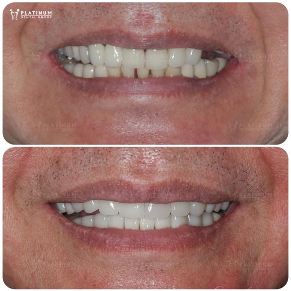 Bọc Răng Sứ Có Cần Lấy Tủy Không? Lấy Tủy Răng Có Bị Đau Không? 7 Bọc răng sứ là bước phục hình cần thiết để bảo vệ răng, giúp khôi phục thẩm mỹ và khả năng ăn nhai