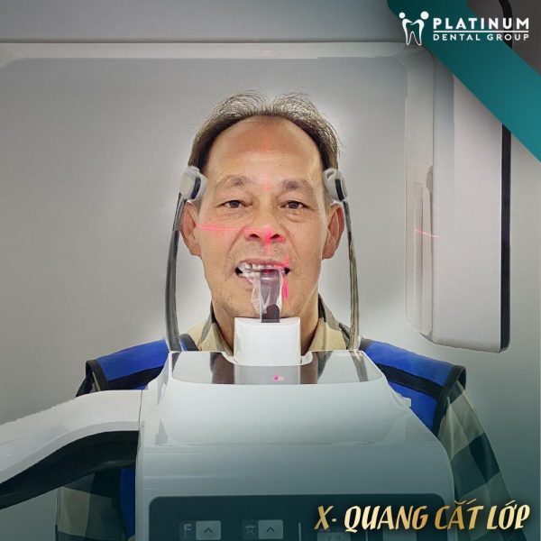 Bọc Răng Sứ Có Cần Lấy Tủy Không? Lấy Tủy Răng Có Bị Đau Không? 9 CT Cone Beam - công nghệ hiện đại bậc nhất, hỗ trợ tối ưu trong quá trình thăm khám nha khoa