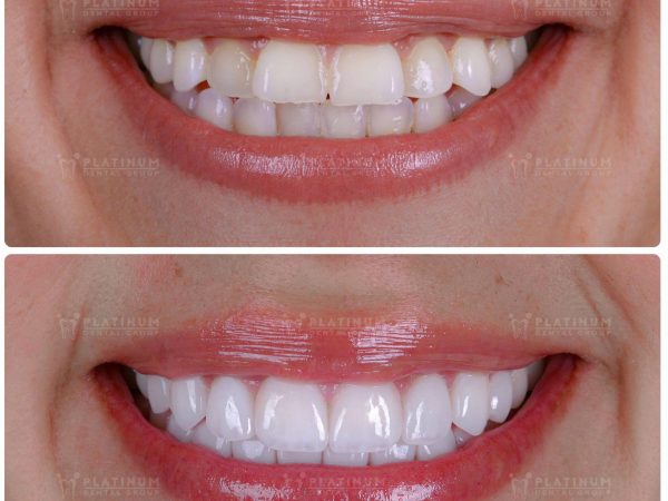 Dán răng sứ không mài - Giải pháp thẩm mỹ không xâm lấn 1 Dán răng sứ không mài là phương pháp phục hình gắn trực tiếp một lớp sứ mỏng chuyên dụng lên bề mặt răng