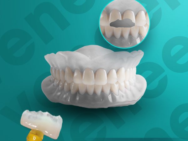 Dán răng sứ không mài - Giải pháp thẩm mỹ không xâm lấn 2 Dán răng sứ không mài áp dụng cho trường hợp nào?