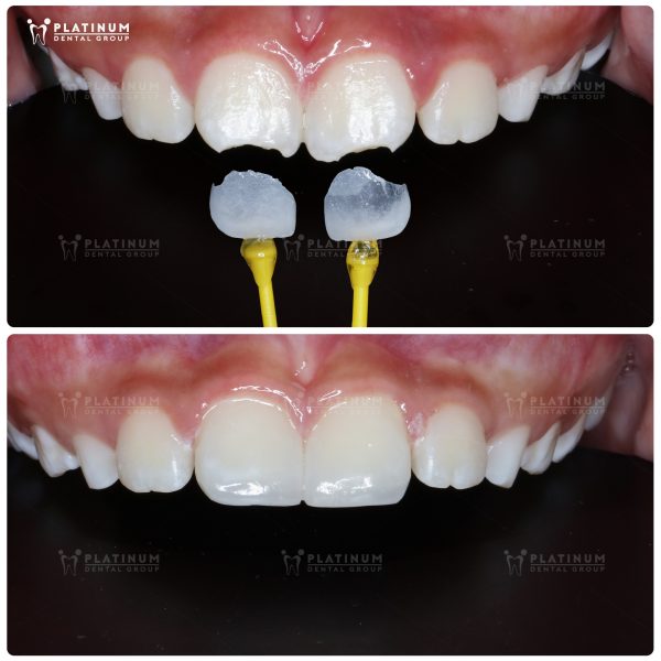 Dán răng sứ không mài - Giải pháp thẩm mỹ không xâm lấn 3 Dán răng sứ không mài giúp cấu trúc răng thật được giữ nguyên gần như hoàn toàn