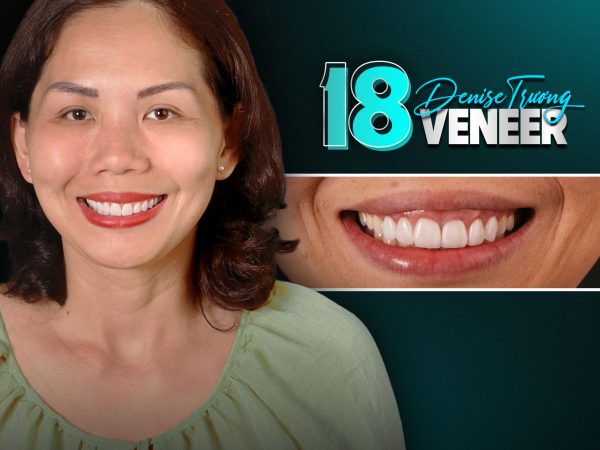 Dán răng sứ không mài - Giải pháp thẩm mỹ không xâm lấn 4 Dán răng sứ không mài mang đến vẻ đẹp tự nhiên